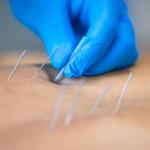The Power of Acupuncture
