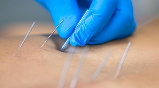 The Power of Acupuncture