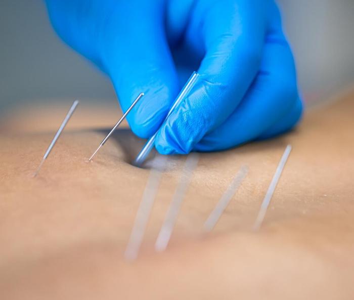 The Power of Acupuncture