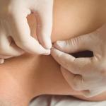 Why Acupuncture is the Future of Holistic Healing