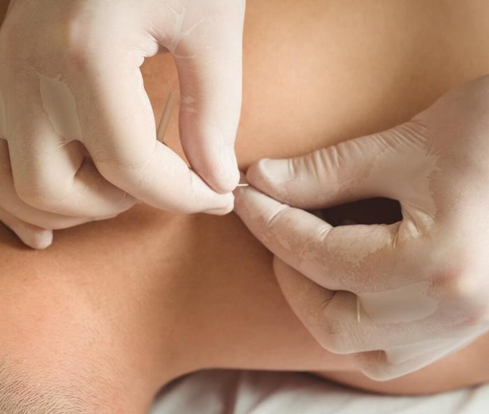 Why Acupuncture is the Future of Holistic Healing